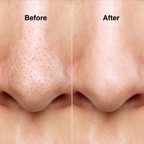 Super Micro Bubble Facial Cleansing Device & Blackhead Remover