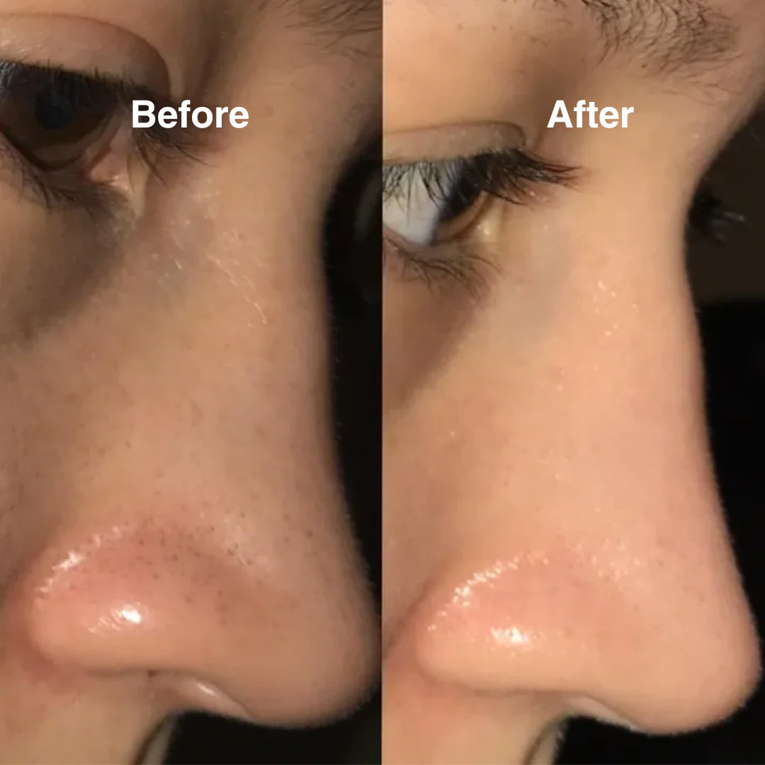 Super Micro Bubble Facial Cleansing Device & Blackhead Remover